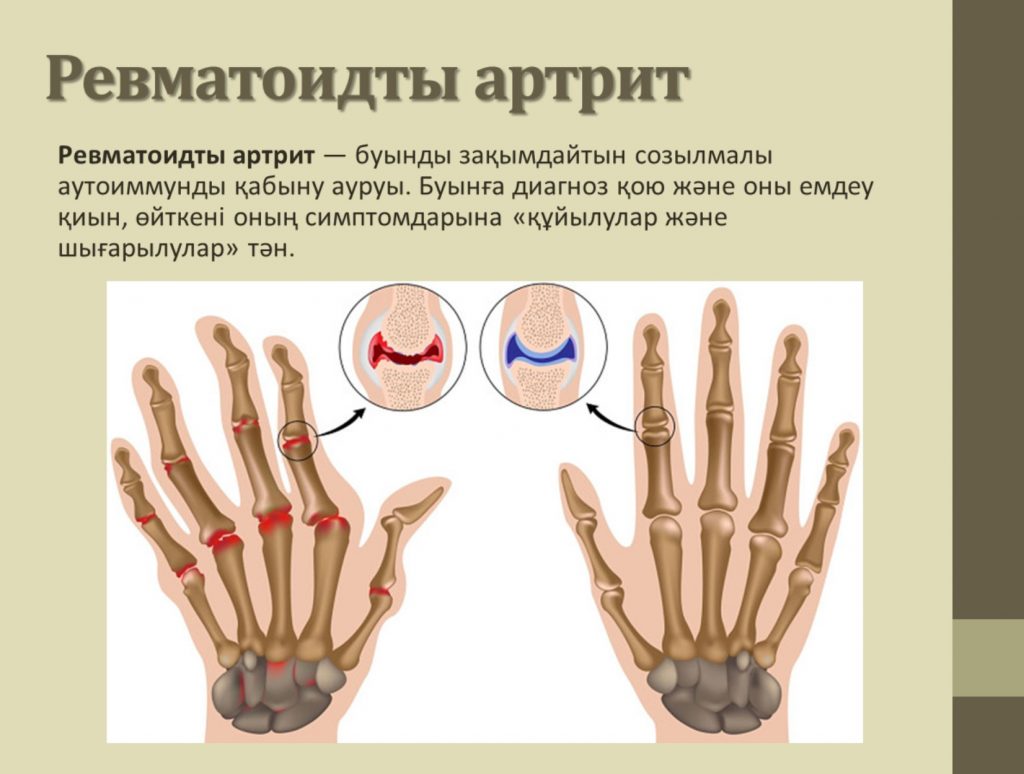 Ревматоидный артрит картинки